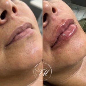 Preenchimento Labial