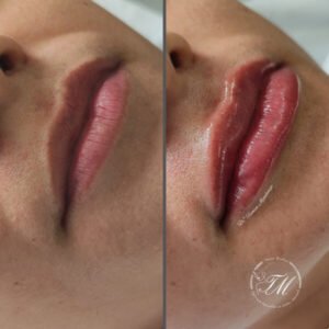 Preenchimento Labial
