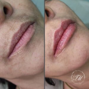 Preenchimento Labial