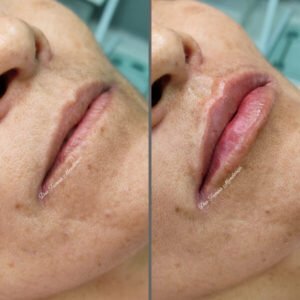 Preenchimento Labial