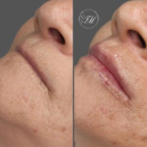 Preenchimento Labial