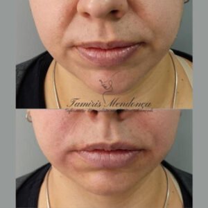 Preenchimento facial