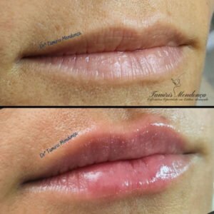 Preenchimento Labial