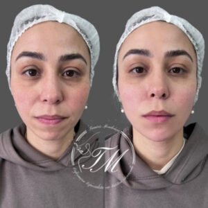 Preenchimento facial