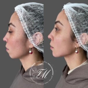 Preenchimento facial