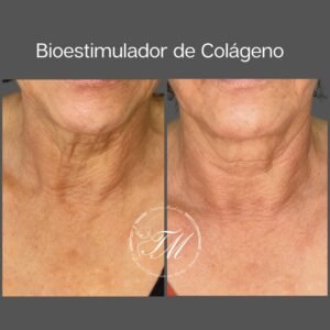 Bioestimulador de colágeno